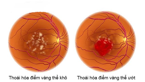 các loại thoái hóa điểm vàng